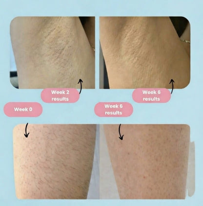 NovaSilk Professional IPL Laser Hair Removal Device